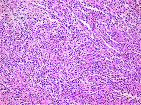 spindle cell carcinoma pathology outlines